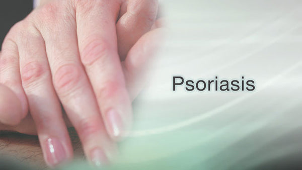 Can CBD help with psoriasis?