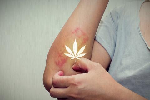 Could Cannabidiol Show Potential for Wound Healing?