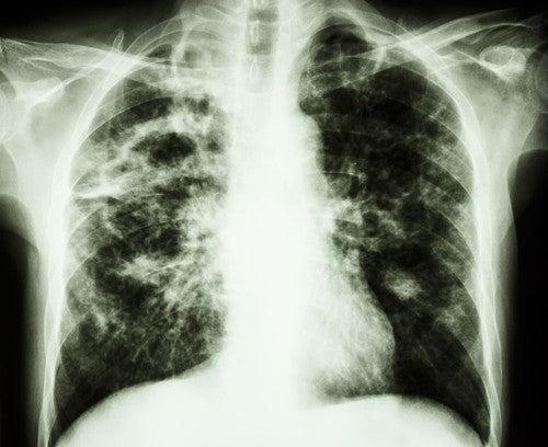 Cannabis and CBD oil for Lung Disease