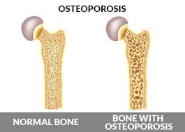 CBD and Osteoporosis
