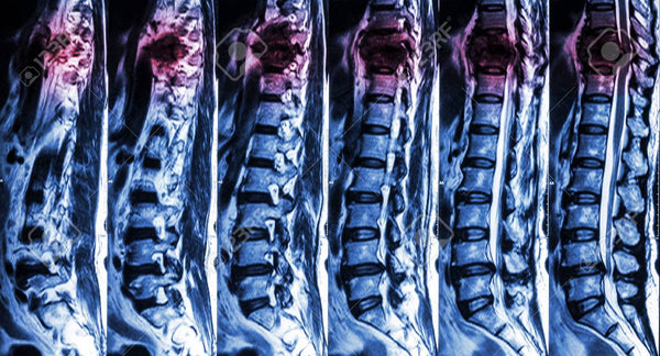 CBD and Spinal Cord Injuries
